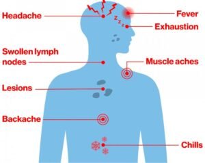 monkey pox symptoms